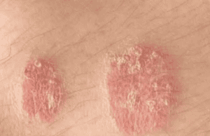 Understanding Psoriasis: A Comprehensive Overview