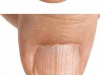 Understanding Nail Ridges: What They Could Mean for Your Health