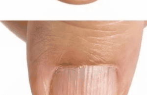 Understanding Nail Ridges: What They Could Mean for Your Health