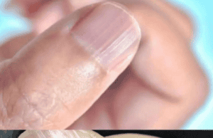 Rippled Fingernails: What They Reveal About Your Health
