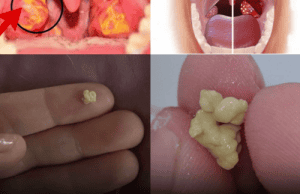 Here’s What You Need to Know About Tonsil Stones
