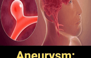12 Signs That May Signal a Brain Aneurysm – Don’t Ignore Them