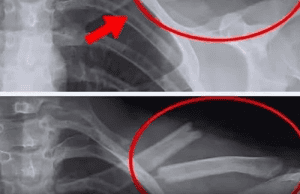 This Poison Will Destroy Your Bones — But You Drink It Every Day