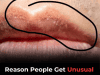 Why You Might Notice Unusual White Bumps on Your Lips — Or Genitals