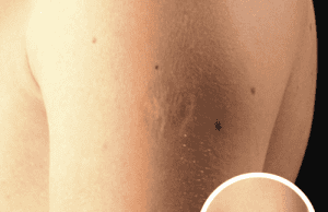 Here’s the Truth Behind That Scar on Your Upper Left Arm