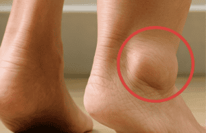 Swollen Legs: Understanding the Symptoms, Causes, and Treatments