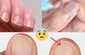 Doctor Reveals 7 Health Issues Hidden in Your Nails — What They Could Be Telling You