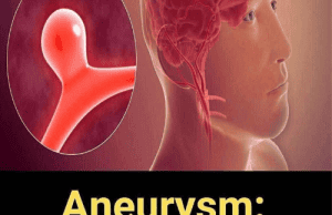 12 Signs That May Signal a Brain Aneurysm β And Why You Should Never Ignore Them