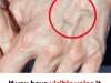 When to Worry About Veins That Suddenly Appear