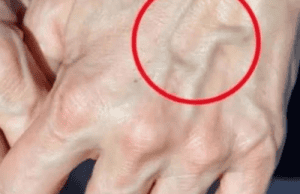When to Worry About Veins That Suddenly Appear