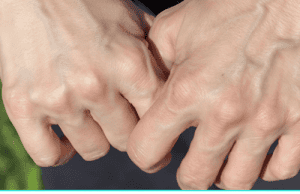 Why Are My Veins Suddenly Bulging and Visible? Here’s What You Need to Know