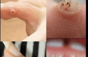 Be Very Careful: If You Notice This Skin Growth, It Could Be Serious