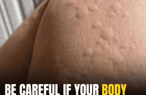 Surprising Causes of Hives Revealed — What’s Really Triggering Your Skin Reaction